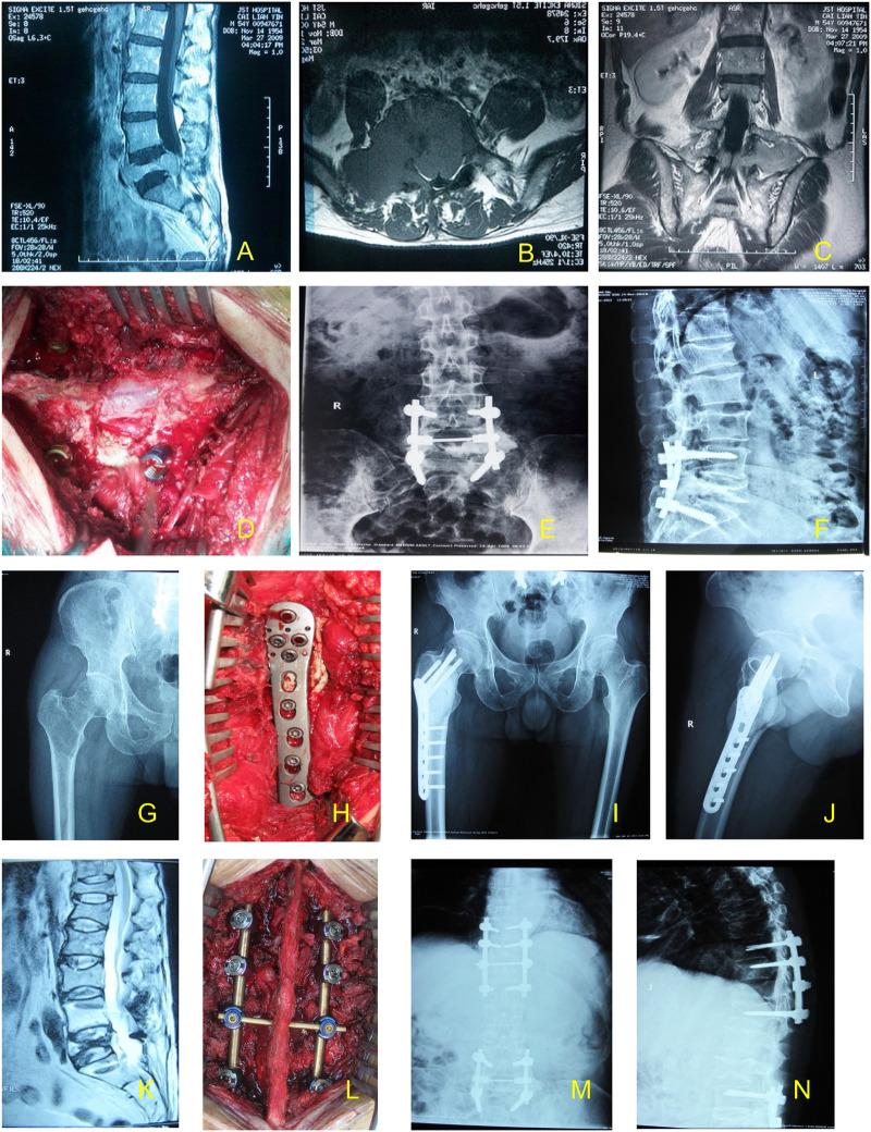 https://cdn.ncbi.nlm.nih.gov/pmc/blobs/2c11/11693696/bcfdae35c9b1/fsurg-11-1433265-g006.jpg
