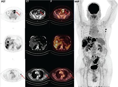 https://cdn.ncbi.nlm.nih.gov/pmc/blobs/2c5b/7057728/3342a2ecdd09/MIRT-29-17-g1.jpg