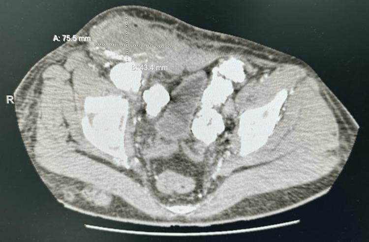 https://cdn.ncbi.nlm.nih.gov/pmc/blobs/2c69/10229102/22a9562f9d1c/cureus-0015-00000038345-i02.jpg