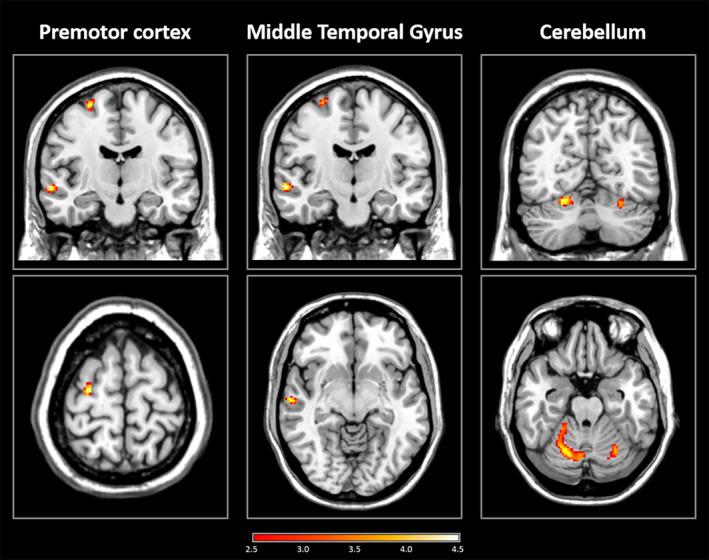 https://cdn.ncbi.nlm.nih.gov/pmc/blobs/2c78/7267908/0d1c8e3c0e98/HBM-41-442-g003.jpg