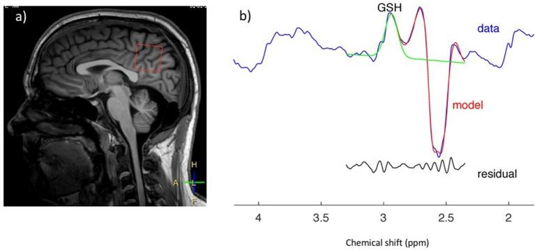 https://cdn.ncbi.nlm.nih.gov/pmc/blobs/2c79/6456669/456325cea4bb/fneur-10-00291-g0003.jpg