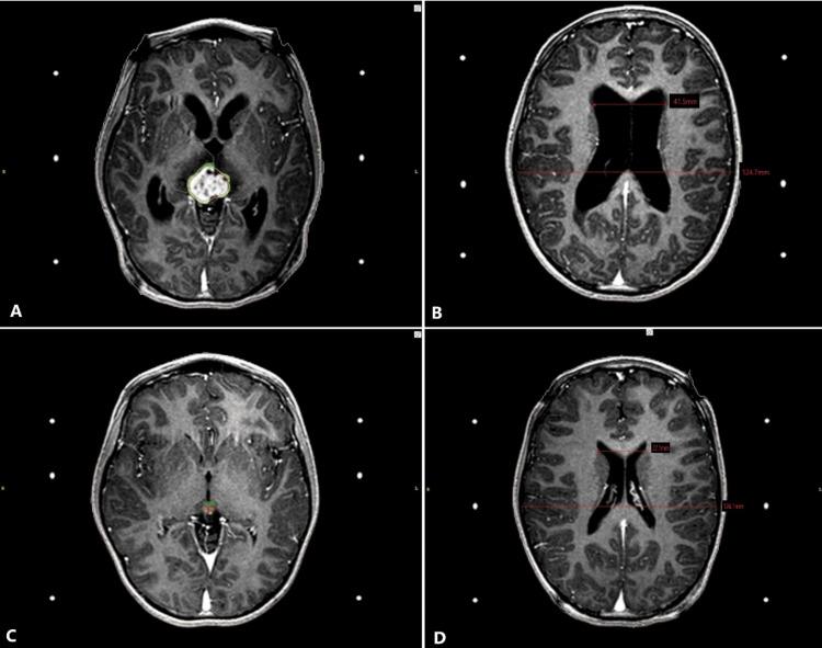 https://cdn.ncbi.nlm.nih.gov/pmc/blobs/2c82/9560016/0e845ae15cf8/cureus-0014-00000029129-i01.jpg