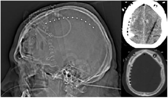 https://cdn.ncbi.nlm.nih.gov/pmc/blobs/2c9a/9849676/fb90753786db/fneur-13-1091987-g0002.jpg