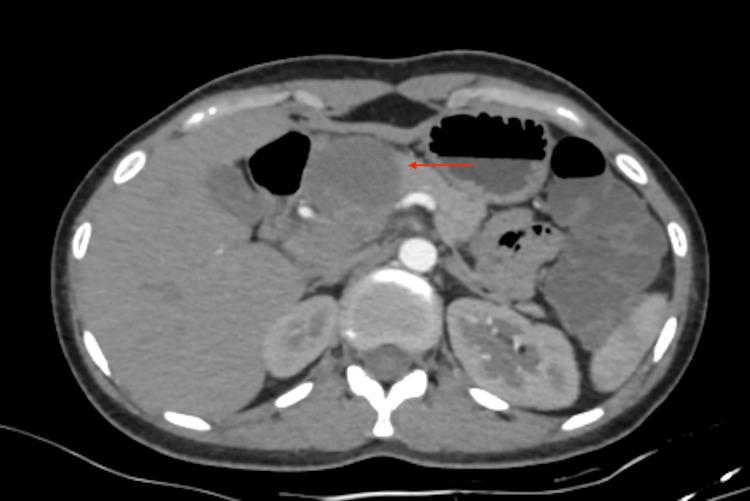 https://cdn.ncbi.nlm.nih.gov/pmc/blobs/2d60/12369668/3b1e4776b913/cureus-0017-00000088521-i03.jpg