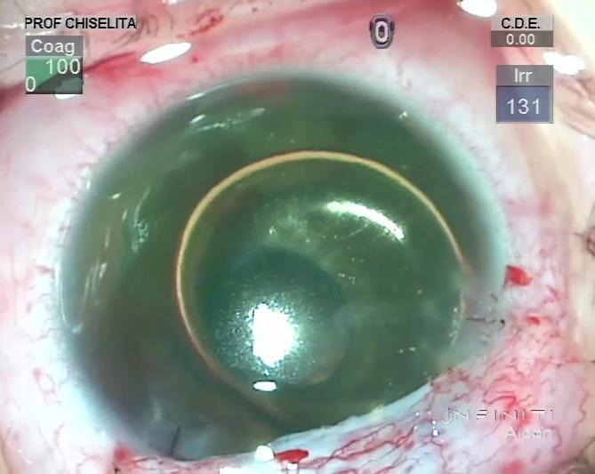 https://cdn.ncbi.nlm.nih.gov/pmc/blobs/2d6a/5710043/997f6633f727/RomJOphthalmol-61-229-g005.jpg