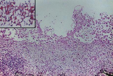 https://cdn.ncbi.nlm.nih.gov/pmc/blobs/2d6a/5710043/df5c23109b80/RomJOphthalmol-61-229-g0011.jpg