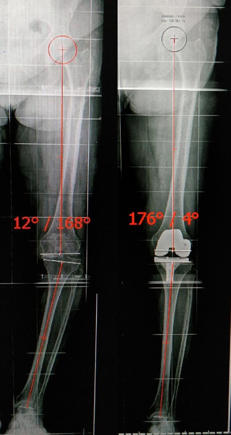 https://cdn.ncbi.nlm.nih.gov/pmc/blobs/2d75/8958131/695b29d948d5/cureus-0014-00000022553-i02.jpg