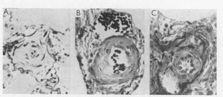 https://cdn.ncbi.nlm.nih.gov/pmc/blobs/2d85/503367/15a0e91255f4/brheartj00379-0111-c.jpg