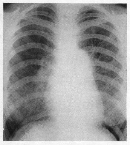 https://cdn.ncbi.nlm.nih.gov/pmc/blobs/2d85/503367/207e3514bcd9/brheartj00379-0101-d.jpg