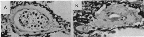 https://cdn.ncbi.nlm.nih.gov/pmc/blobs/2d85/503367/27920e36d9aa/brheartj00379-0112-a.jpg