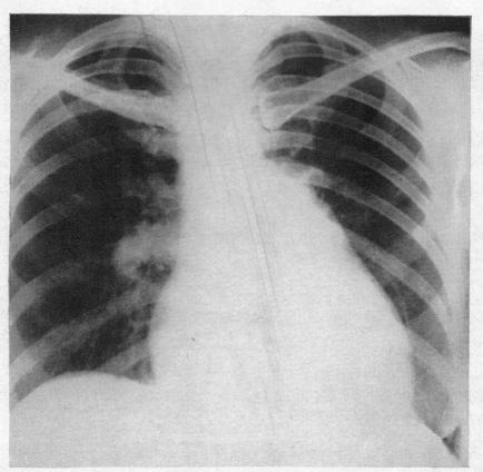 https://cdn.ncbi.nlm.nih.gov/pmc/blobs/2d85/503367/999a916bda5d/brheartj00379-0101-c.jpg