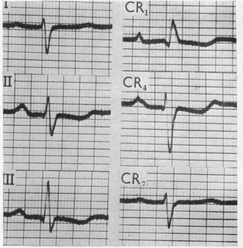 https://cdn.ncbi.nlm.nih.gov/pmc/blobs/2d85/503367/ba0b5916bb37/brheartj00379-0102-b.jpg