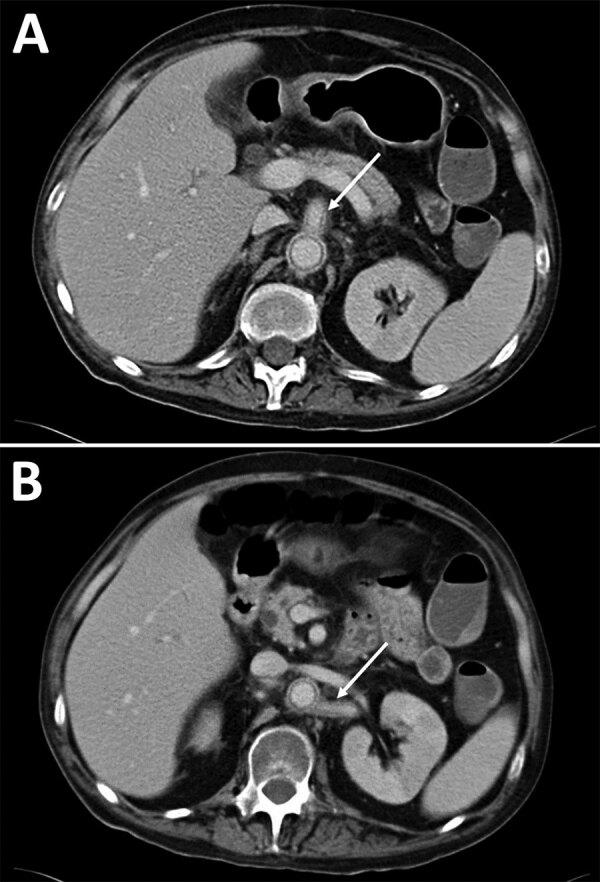 https://cdn.ncbi.nlm.nih.gov/pmc/blobs/2d8d/11138966/dd35339275e6/23-1409-F4.jpg