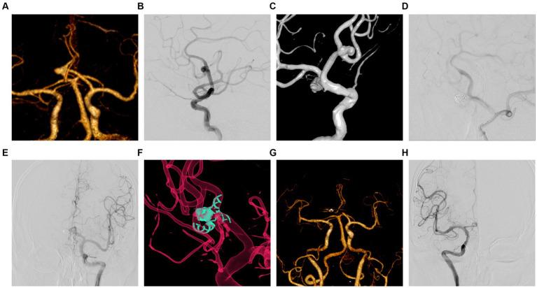 https://cdn.ncbi.nlm.nih.gov/pmc/blobs/2da4/11268080/039065fa2977/fneur-15-1393310-g002.jpg