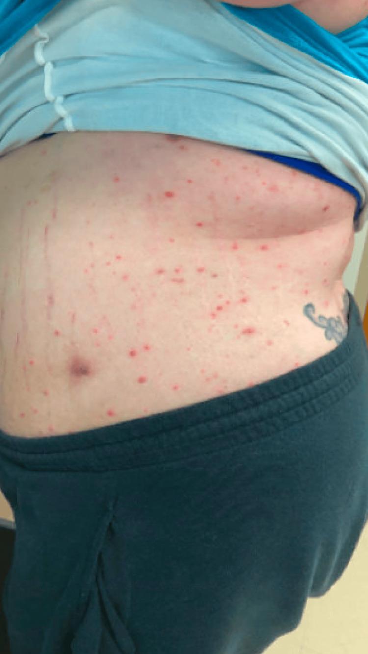 https://cdn.ncbi.nlm.nih.gov/pmc/blobs/2da8/11710852/0175ddc933e5/cureus-0016-00000075402-i05.jpg