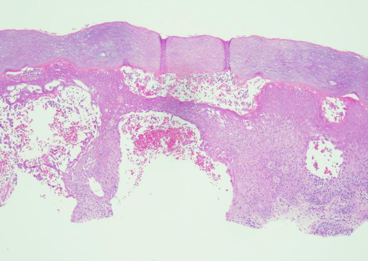https://cdn.ncbi.nlm.nih.gov/pmc/blobs/2da8/11710852/56bf8a6660c7/cureus-0016-00000075402-i06.jpg