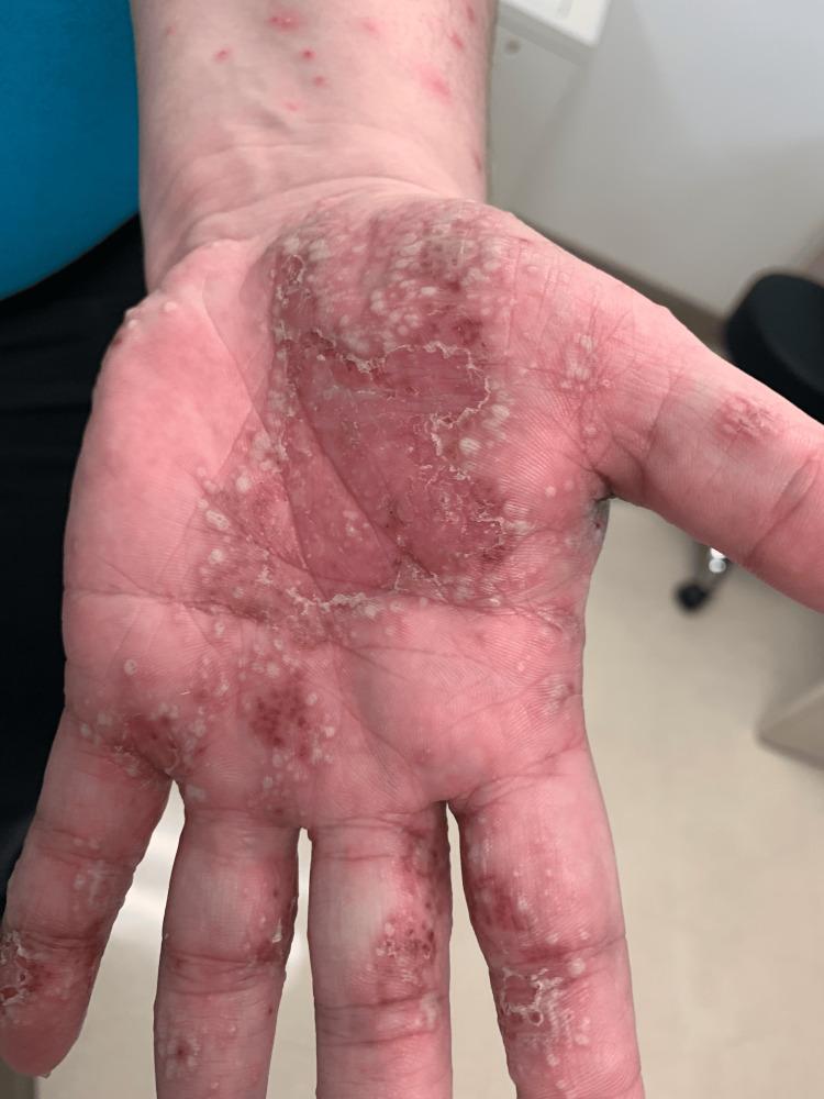 https://cdn.ncbi.nlm.nih.gov/pmc/blobs/2da8/11710852/7e2de49e0ea3/cureus-0016-00000075402-i03.jpg