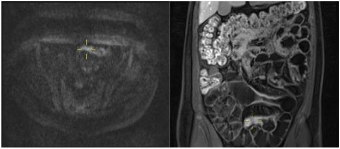 https://cdn.ncbi.nlm.nih.gov/pmc/blobs/2db6/5813850/0e1354a2c785/10.1177_1756283X18757185-fig2.jpg