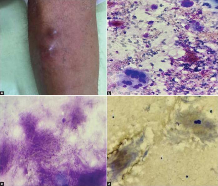 https://cdn.ncbi.nlm.nih.gov/pmc/blobs/2dc6/9479508/4c0a54730102/Cytojournal-19-48-g002.jpg
