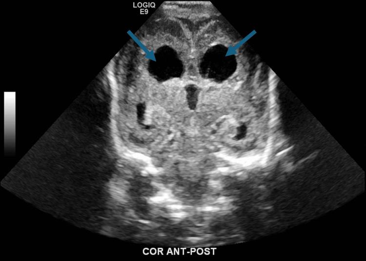https://cdn.ncbi.nlm.nih.gov/pmc/blobs/2de3/11221500/33bf8d0e7a39/cureus-0016-00000061576-i01.jpg