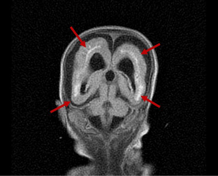 https://cdn.ncbi.nlm.nih.gov/pmc/blobs/2de3/11221500/4c0faeb5657b/cureus-0016-00000061576-i05.jpg