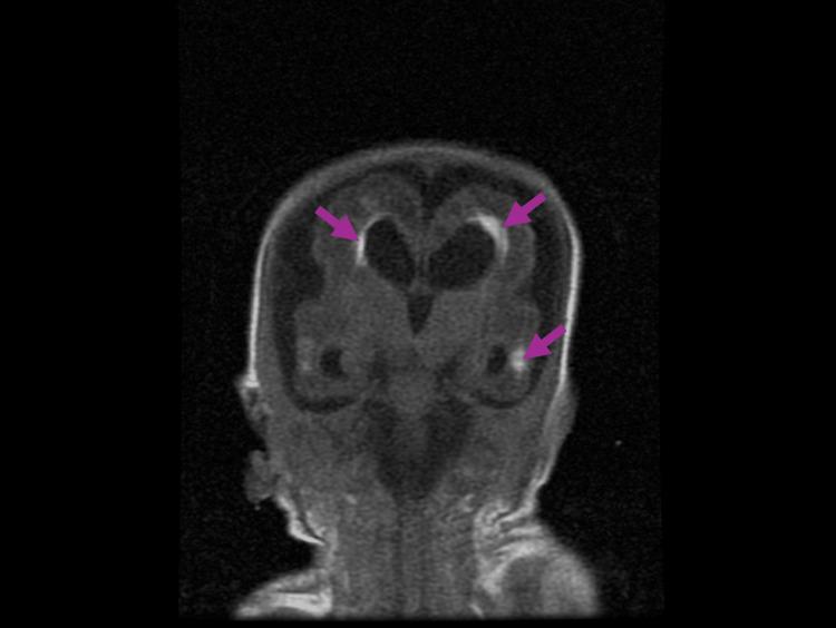 https://cdn.ncbi.nlm.nih.gov/pmc/blobs/2de3/11221500/52b1aaa04766/cureus-0016-00000061576-i07.jpg