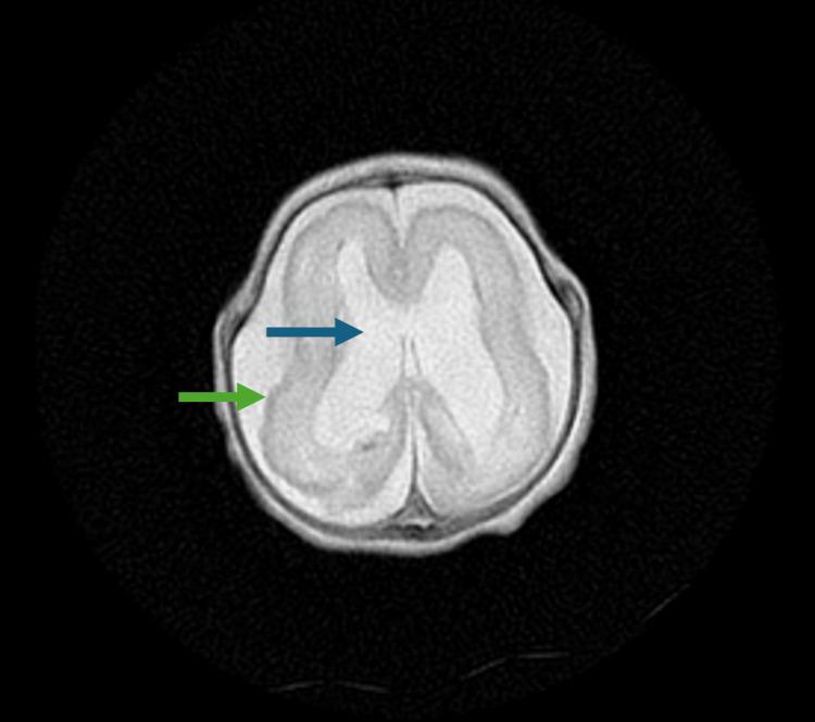 https://cdn.ncbi.nlm.nih.gov/pmc/blobs/2de3/11221500/aeb150c7a509/cureus-0016-00000061576-i06.jpg