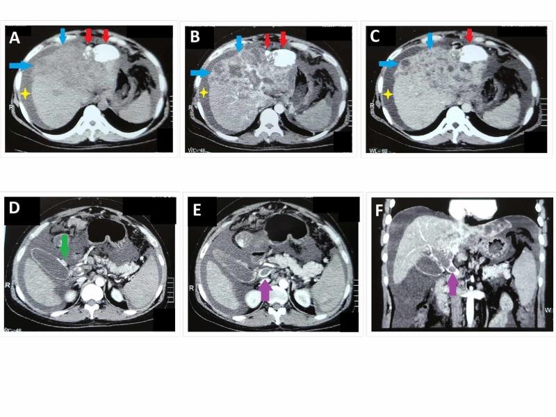 https://cdn.ncbi.nlm.nih.gov/pmc/blobs/2de7/6773453/2261d928bca6/cureus-0011-00000005305-i03.jpg