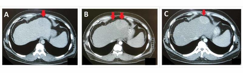 https://cdn.ncbi.nlm.nih.gov/pmc/blobs/2de7/6773453/6862e0aa9882/cureus-0011-00000005305-i01.jpg