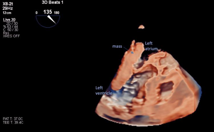 https://cdn.ncbi.nlm.nih.gov/pmc/blobs/2e8a/9237856/291ebc6322bb/cureus-0014-00000025440-i04.jpg