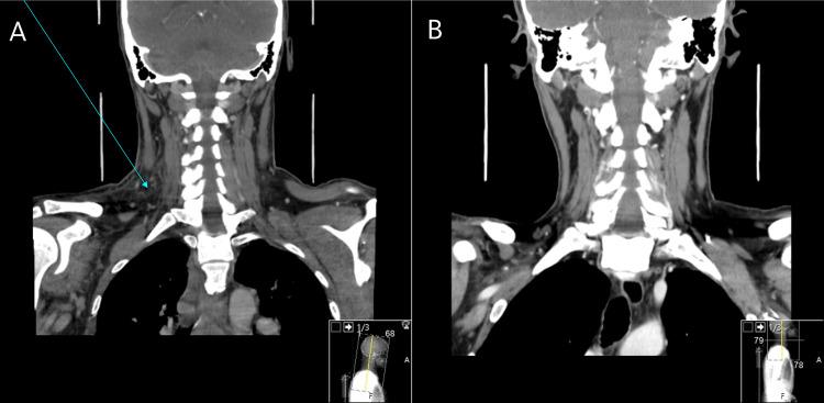 https://cdn.ncbi.nlm.nih.gov/pmc/blobs/2e8c/9897686/4df3491c8460/cureus-0015-00000033456-i03.jpg