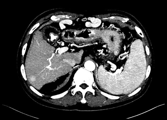 https://cdn.ncbi.nlm.nih.gov/pmc/blobs/2ea3/5402837/acea7a8ffa5c/medscimonit-23-1834-g004.jpg