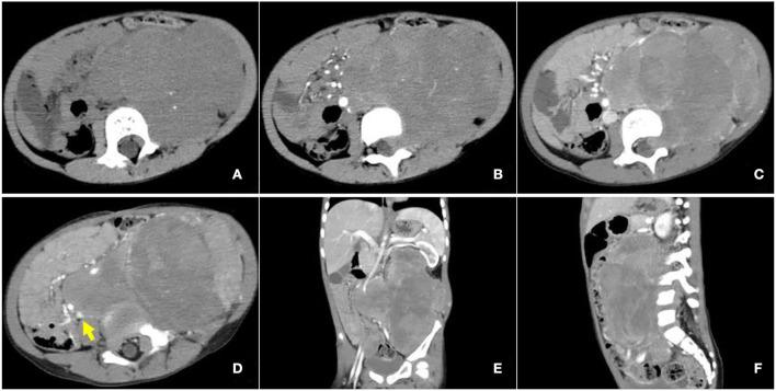 https://cdn.ncbi.nlm.nih.gov/pmc/blobs/2ec1/9670135/b085c1c30abe/fmed-09-1019964-g0002.jpg