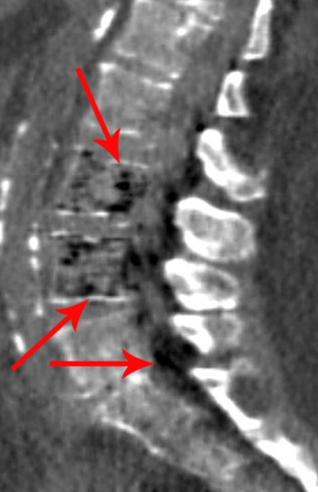 https://cdn.ncbi.nlm.nih.gov/pmc/blobs/2ef0/6913288/1688dc05d129/amjcaserep-20-1793-g003.jpg