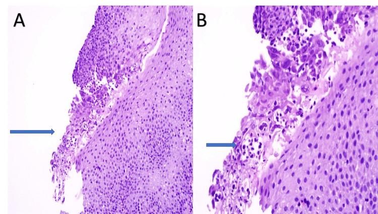 https://cdn.ncbi.nlm.nih.gov/pmc/blobs/2f1b/10550305/996b29c0db68/cureus-0015-00000044668-i02.jpg