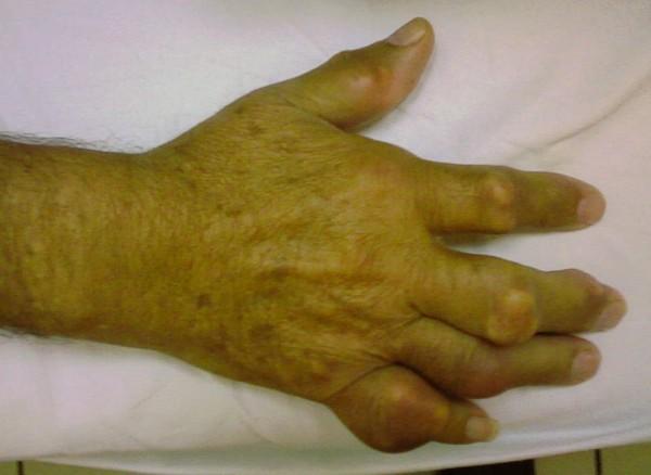 https://cdn.ncbi.nlm.nih.gov/pmc/blobs/2f36/3170636/8033aff9d0f4/1752-1947-5-397-3.jpg