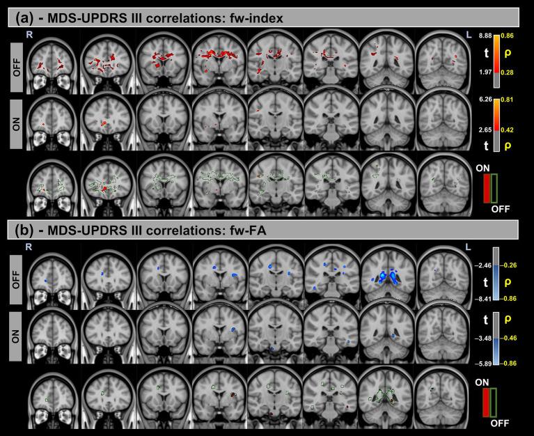 https://cdn.ncbi.nlm.nih.gov/pmc/blobs/2f3c/12283281/202085646878/fneur-16-1605753-g003.jpg