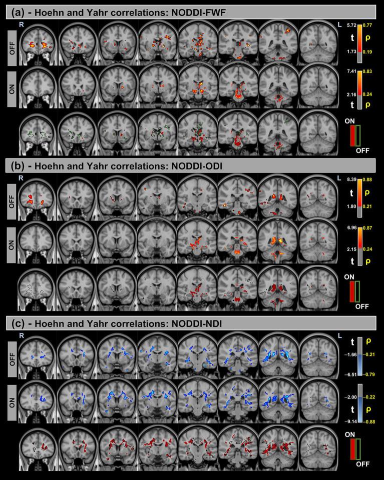 https://cdn.ncbi.nlm.nih.gov/pmc/blobs/2f3c/12283281/78d032809049/fneur-16-1605753-g006.jpg