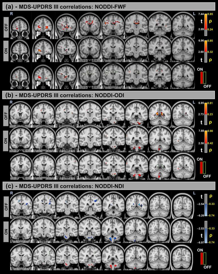 https://cdn.ncbi.nlm.nih.gov/pmc/blobs/2f3c/12283281/b5addd5d18d3/fneur-16-1605753-g005.jpg