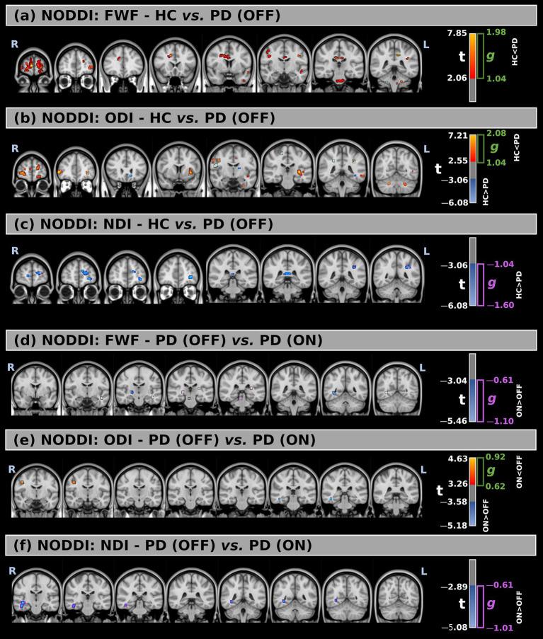https://cdn.ncbi.nlm.nih.gov/pmc/blobs/2f3c/12283281/fd1e69e11530/fneur-16-1605753-g002.jpg