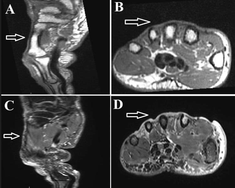 https://cdn.ncbi.nlm.nih.gov/pmc/blobs/2f65/10276311/c721177d5ae6/cureus-0015-00000040553-i03.jpg