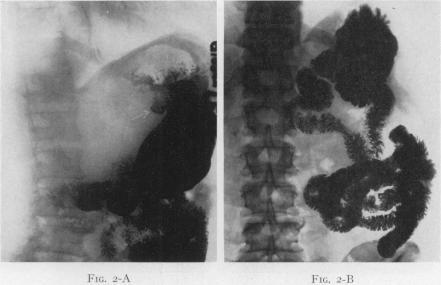 https://cdn.ncbi.nlm.nih.gov/pmc/blobs/2f6f/1803196/06a22492a1a0/annsurg01379-0082-a.jpg