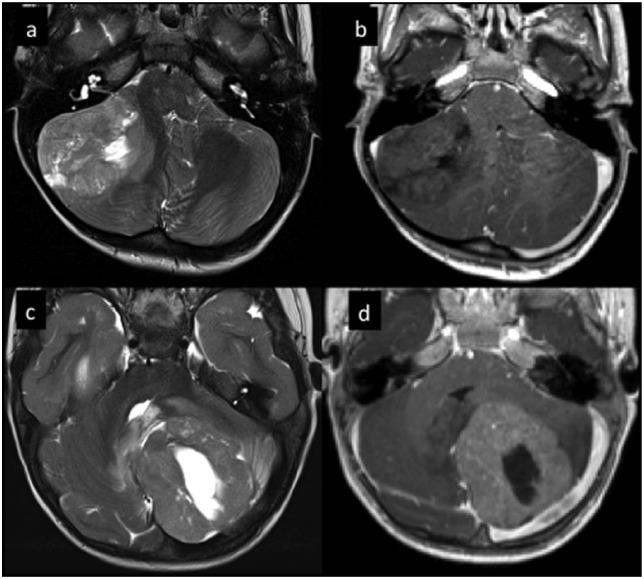 https://cdn.ncbi.nlm.nih.gov/pmc/blobs/2f85/6024494/07b224e42705/10.1177_1756286418775375-fig8.jpg