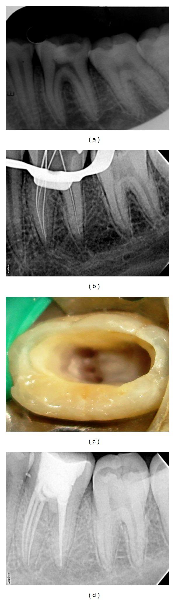 https://cdn.ncbi.nlm.nih.gov/pmc/blobs/2fb7/3389654/8500e6012ce0/CRIM.DENTISTRY2012-103125.001.jpg