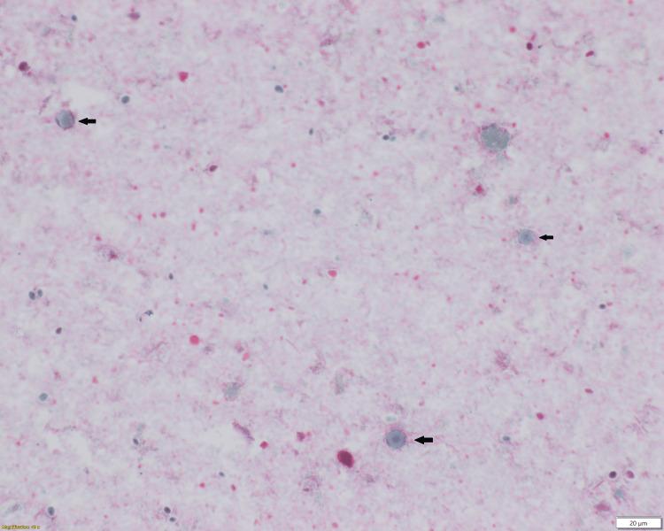 https://cdn.ncbi.nlm.nih.gov/pmc/blobs/2fb8/10517707/8b8d9319ad31/cureus-0015-00000044050-i01.jpg