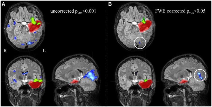 https://cdn.ncbi.nlm.nih.gov/pmc/blobs/2fb8/4101337/67fcbdcb5ec5/fneur-05-00131-g004.jpg
