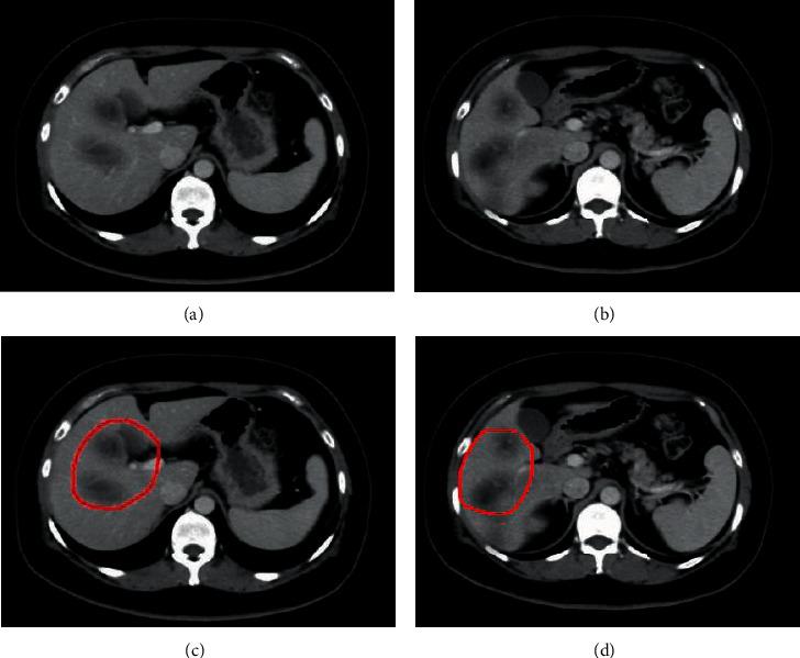 https://cdn.ncbi.nlm.nih.gov/pmc/blobs/3001/9054411/2e05006b3c45/CIN2022-5639820.008.jpg