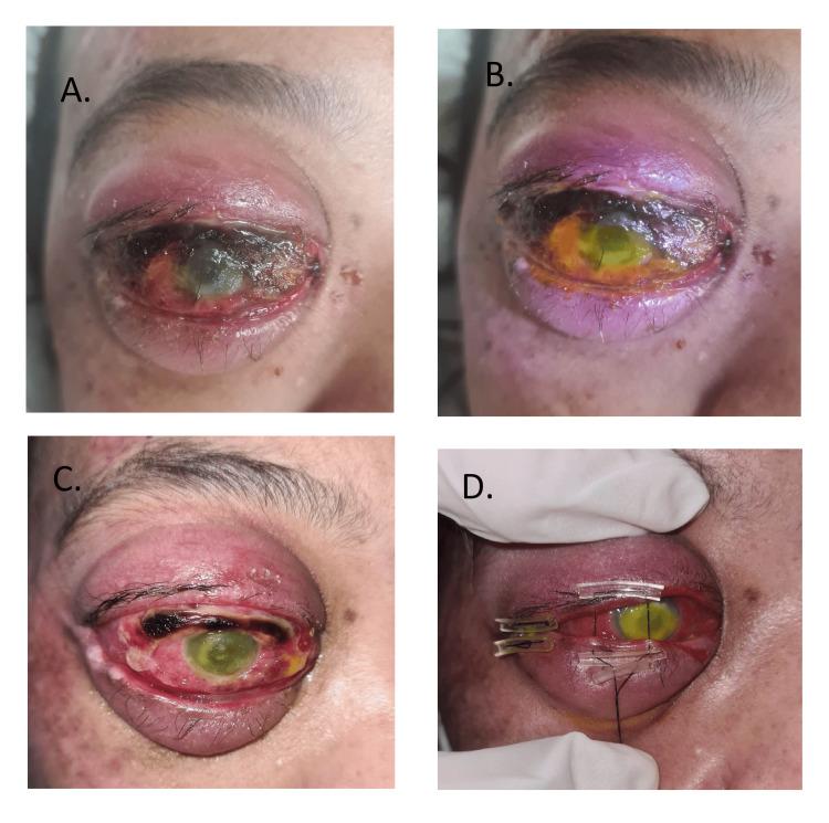 https://cdn.ncbi.nlm.nih.gov/pmc/blobs/302d/11710942/08435e42bfa9/cureus-0016-00000075414-i04.jpg