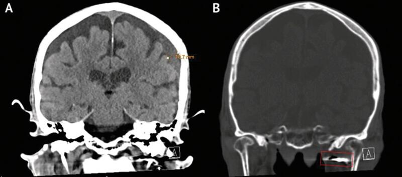 https://cdn.ncbi.nlm.nih.gov/pmc/blobs/3064/12129607/e2669487dcae/10-1055-a-2603-9286_26047854.jpg
