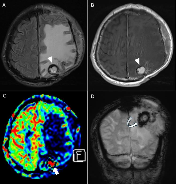 https://cdn.ncbi.nlm.nih.gov/pmc/blobs/3083/12162386/f78eeda71753/cureus-0017-00000084035-i06.jpg